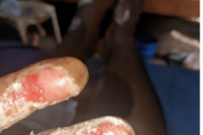 posko kedelapan kota Larantuka, warga pengungsian dari desa hokeng jaya. keluarga memilih mengungsi mandiri untuk perawatan secara khusus dari tim kesehatan Rumag Sakit Damian Lewoleba Lembata suami dan istri mengalami luka barkar dan yang paling ssedih yakni rumah hangus dilahap api dan hujan abuh erupsi