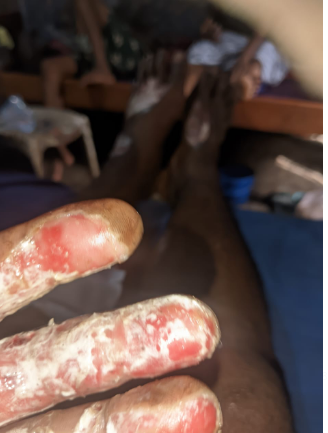 posko kedelapan kota Larantuka, warga pengungsian dari desa hokeng jaya. keluarga memilih mengungsi mandiri untuk perawatan secara khusus dari tim kesehatan Rumag Sakit Damian Lewoleba Lembata suami dan istri mengalami luka barkar dan yang paling ssedih yakni rumah hangus dilahap api dan hujan abuh erupsi